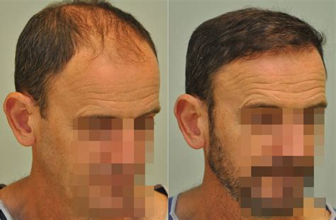 siko shop|sikos hair transplant.